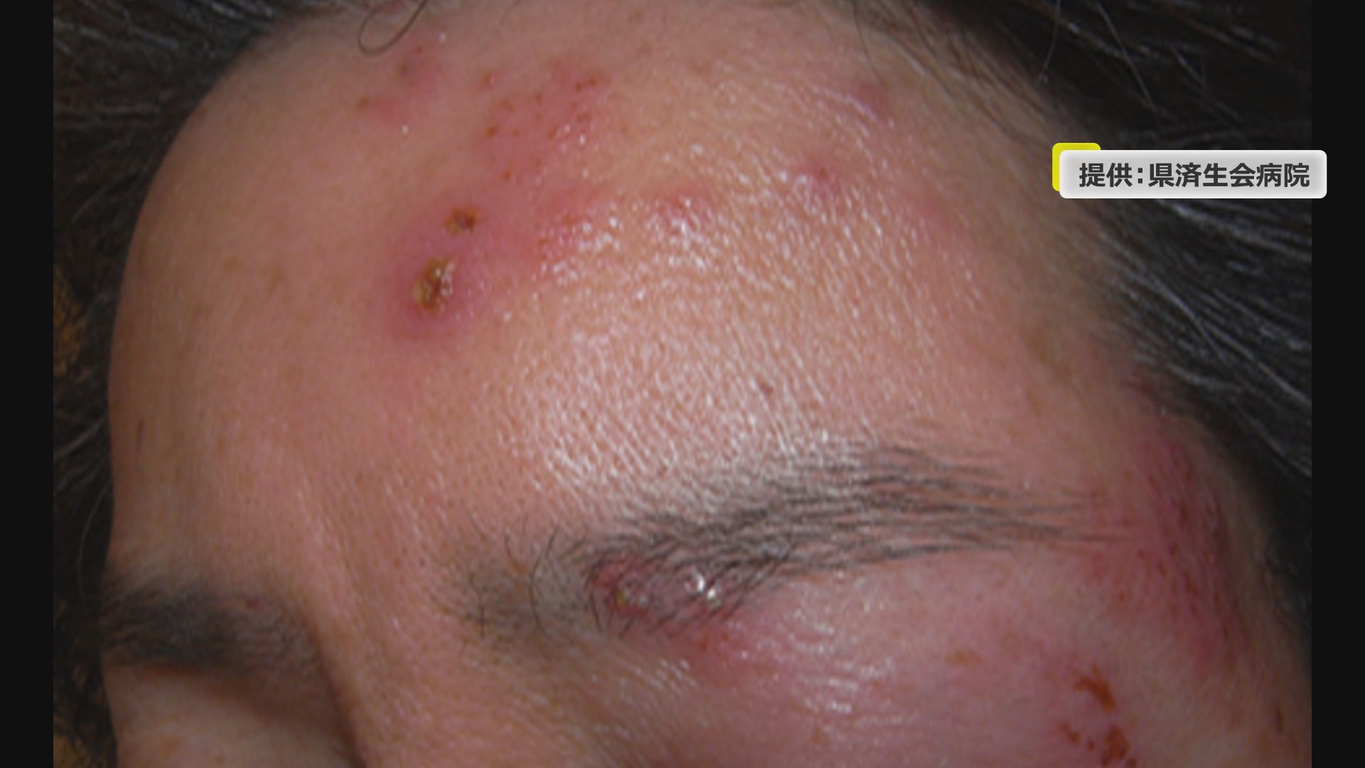 帯状疱疹（提供：福井県済生会病院）