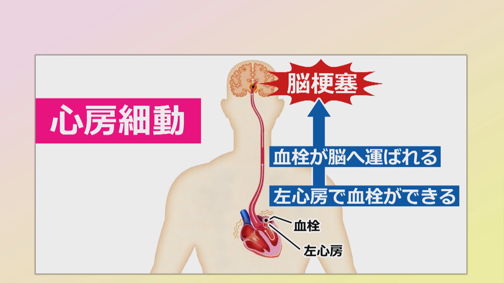 警戒が必要な心房細動