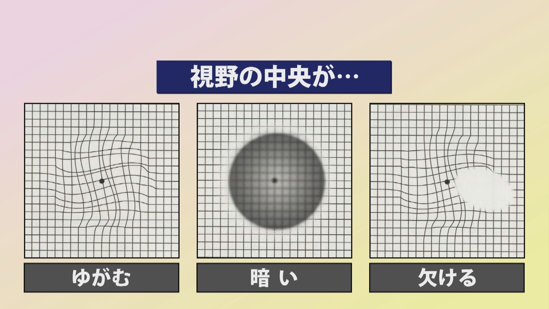加齢黄斑変性の症状