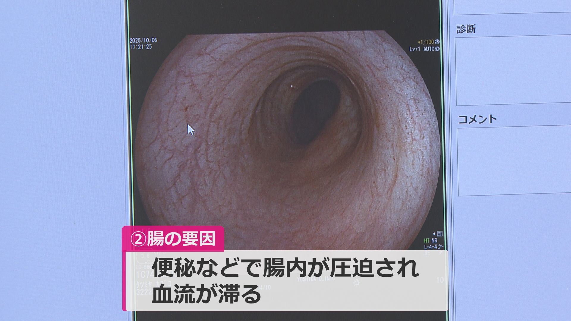 大腸壁が虚血に陥ることで発症
