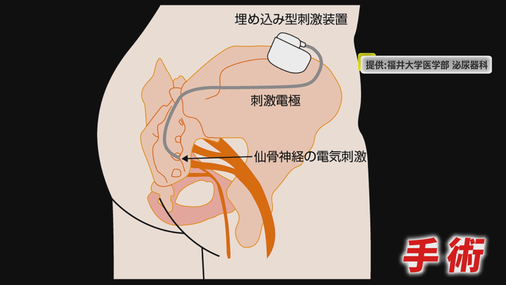 ペースメーカー埋め込み手術